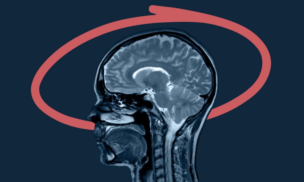 O proteină a creierului ar putea explica răspândirea bolii Alzheimer. Descoperirea deschide o nouă direcție pentru viitoarele tratamente