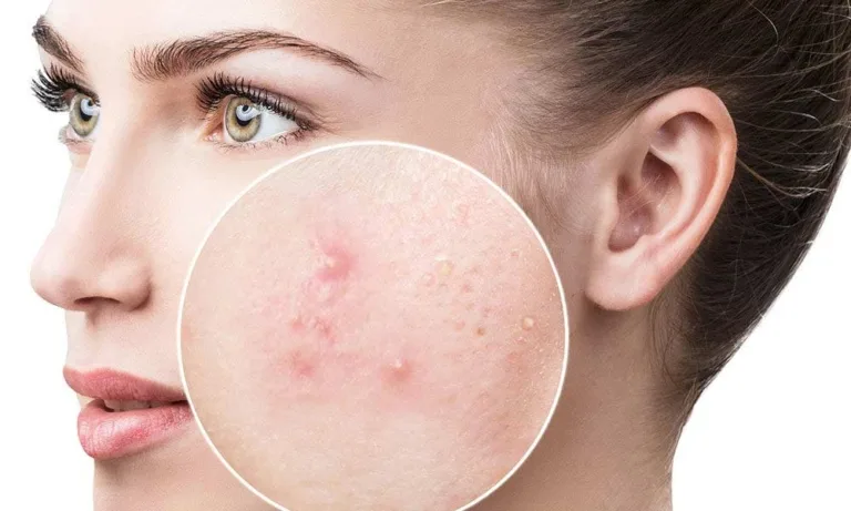 Bronzul nu tratează acneea. Dr. Maria-Roxana Caunic, dermatolog: „Efectul este doar temporar, iar ulterior leziunile se pot agrava” 