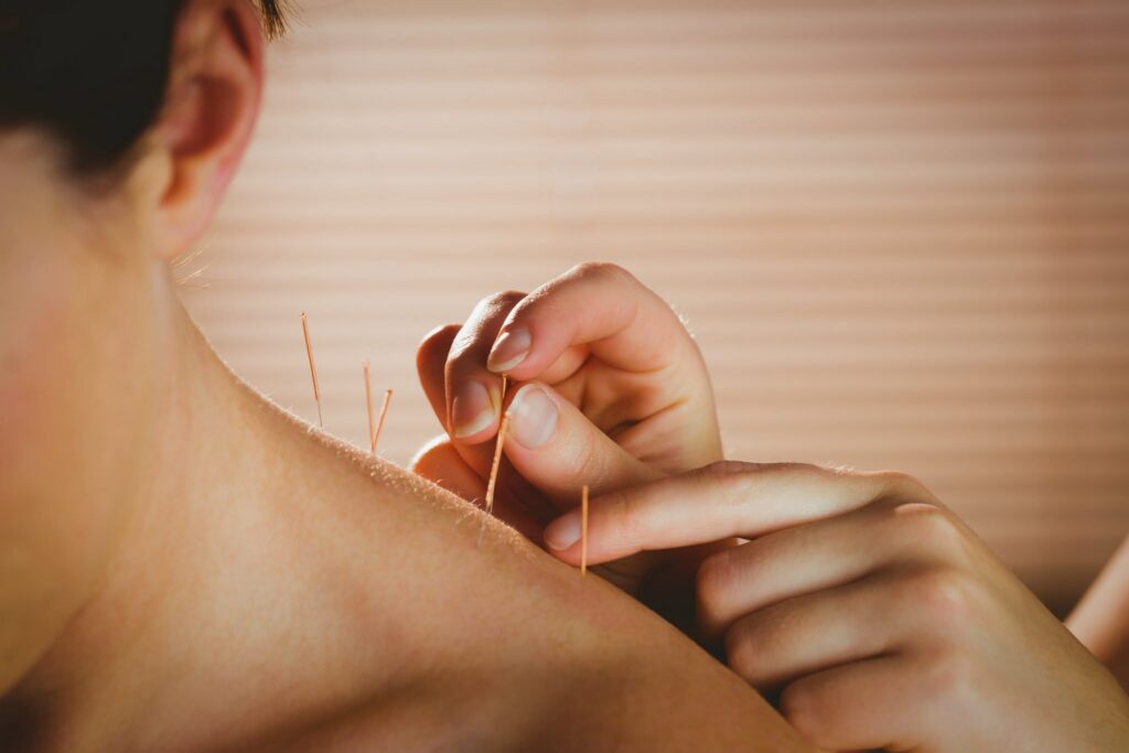 Cât costă o ședință de acupunctură. Prețurile pornesc de la 100 de lei