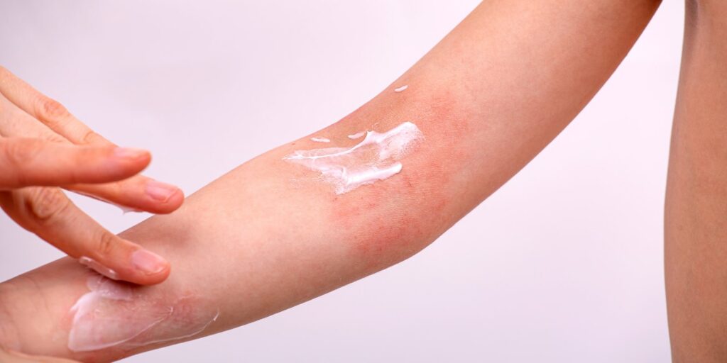 Pielea uscată, de la disconfort la fisuri. Când e timpul pentru dermatolog